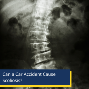 Xray of scoliosis - can a car accident cause scoliosis?
